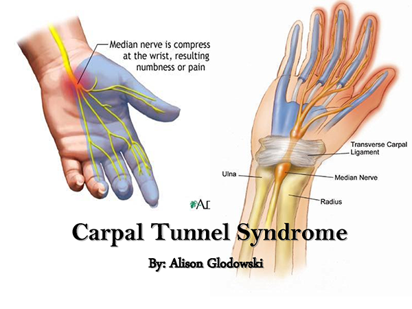 Carpal Tunnel Syndrome Dr Bill Tran Laser Acupuncture